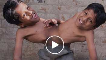 VIDEO: पेट से जुड़े इन भाइयों की जिंदगी है मिसाल, बोले- 'जब तक जिएंगे, साथ रहेंगे' VIDEO: पेट से जुड़े इन भाइयों की जिंदगी है मिसाल, बोले- 'जब तक जिएंगे, साथ रहेंगे'