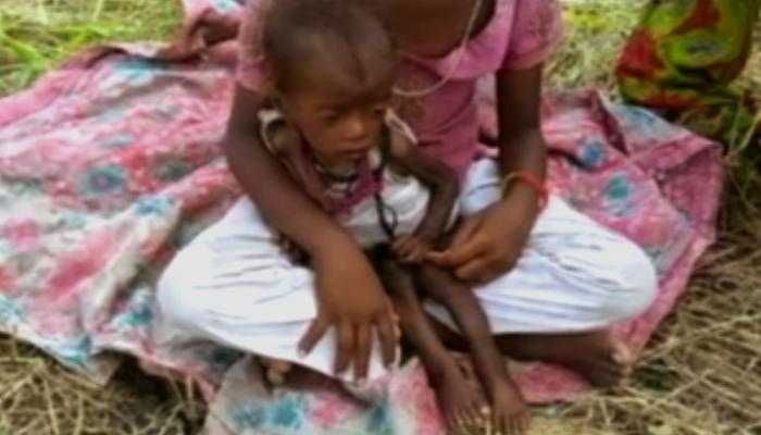एक मासूम को निगल गया कुपोषण का राक्षस, जागो सरकार एक मासूम को निगल गया कुपोषण का राक्षस, जागो सरकार